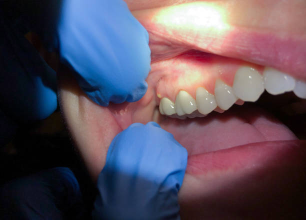 Best Emergency Dental Extractions in Olney, IL